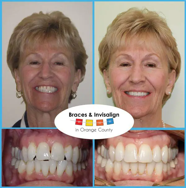 Barbra Before and After