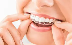 Invisalign Worn By A Woman